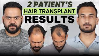Information Hair Transplant in India (HX-ZRES) | Best Results & Cost of Hair Transplant in India Guide