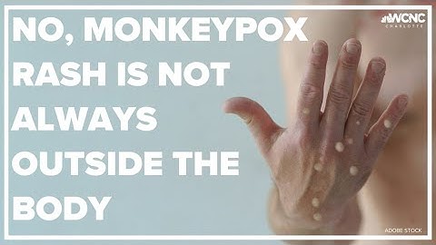 VERIFY: No, a monkeypox rash is not always outside the body