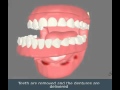 Immediate Dentures