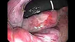 Colonoscopy of Ulcerated Internal Hemorrhoid and Rubber Band Treatment