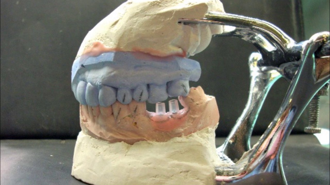 Fabricación de Coronas de Porcelana sobre Implantes