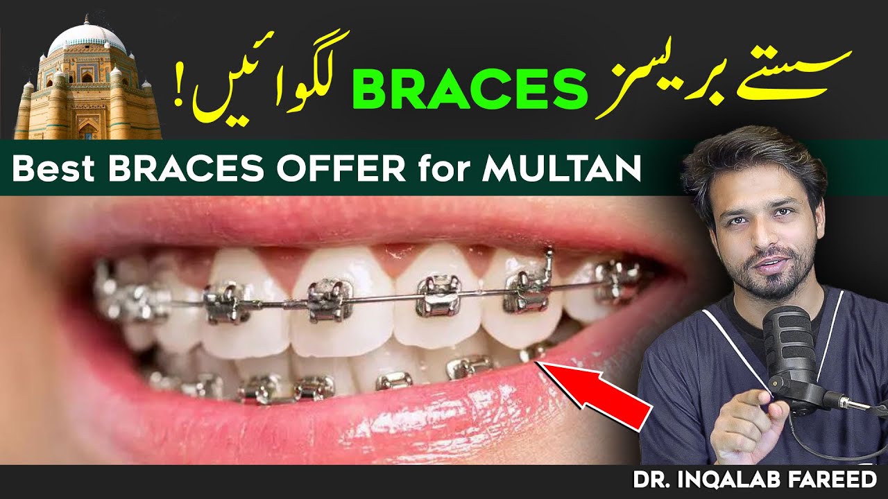 Best Braces Treatment in Multan! | Very Affordable | 