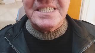 Tcsbio Thermoplasztikus Fogsorok