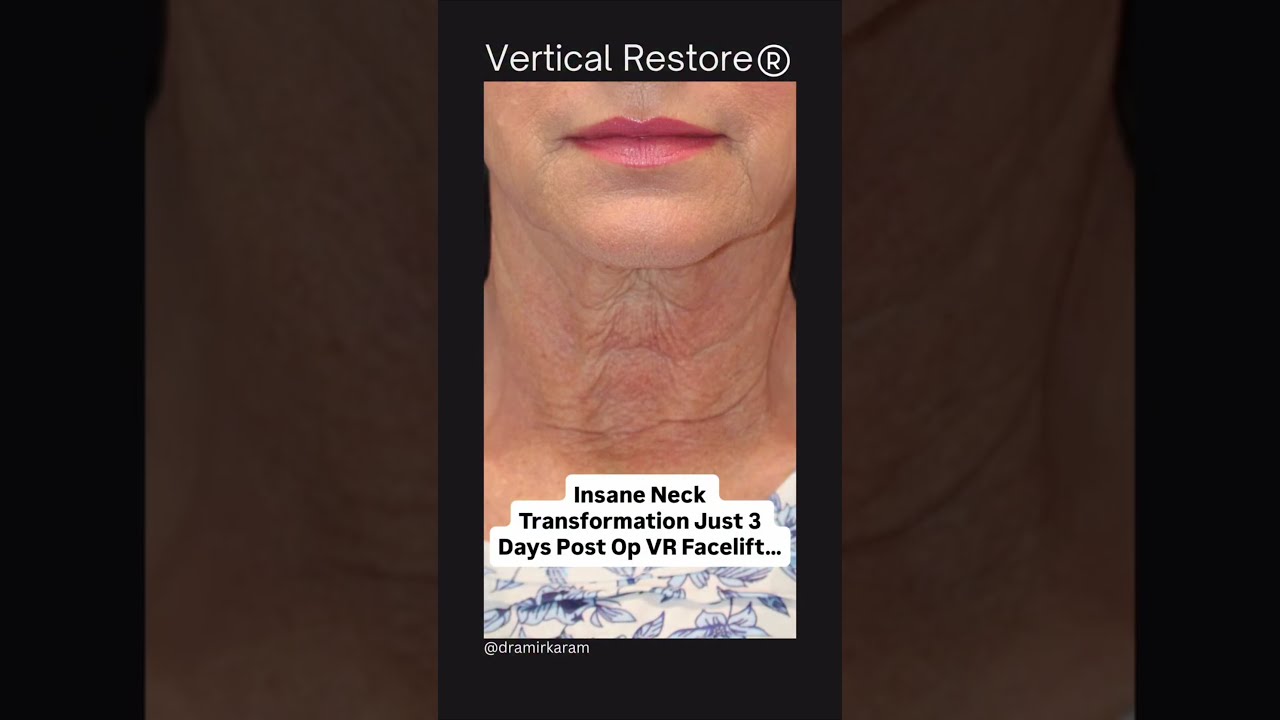 Unbelievable 3 Day Neck Transformation