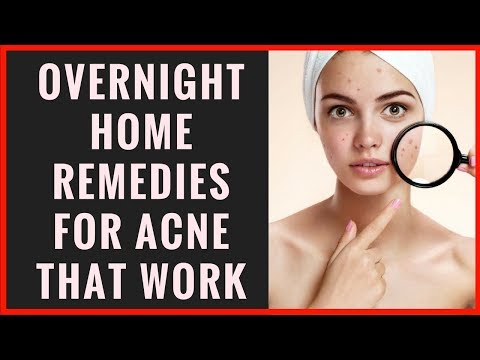 Overnight Home Remedies for Acne Scars, Pimples, Forehead, Blackheads on Face to get clear skin