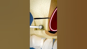 Sinus Lift Surgery Explained 🤔