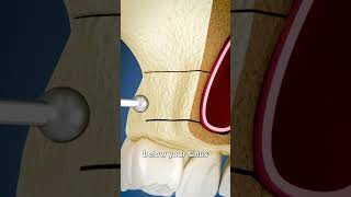 sinus lift surgery explained 🤔