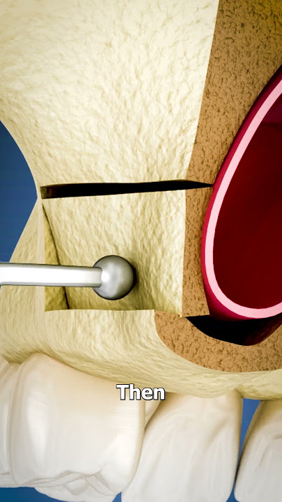 Sinus Lift Surgery Explained 🤔