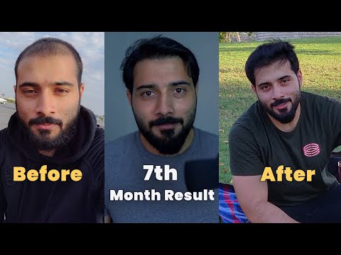 My 7th Month Hair Transplant Result Timeline in Pakistan | Before and After Photos