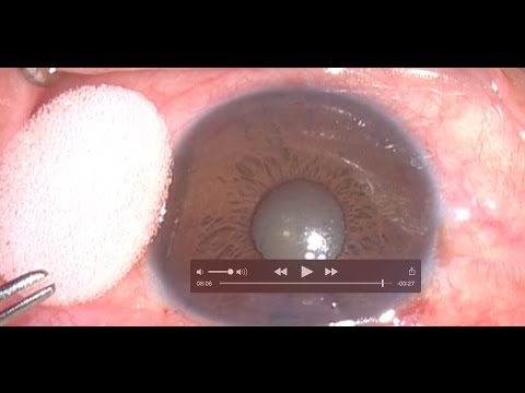 Vidéo N° 6  Centre du Glaucome:Trabeculectomie Step by Step /Dr Ezzouhairi