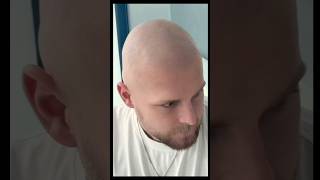 Feel free again from hair loss.SMP by Marcin Adam #hairtattoo scalpmicropigmentation #smp