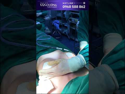 Video Ths.Bs Văn Cường Phẫu Thuật Nâng Ngực cho chị khách... - youtube