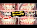 Braces off after 2 years - Complete journey - Tooth Time Family Dentistry New Braunfels