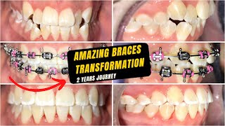 Braces off after 2 years - Complete journey - Tooth Time Family Dentistry New Braunfels