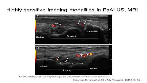 Treating to Target in PsA and SpA – Are We There Yet?