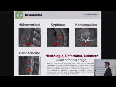 Video: 4 Möglichkeiten zur Behandlung von Kompressionsfrakturen mit Rückenchirurgie