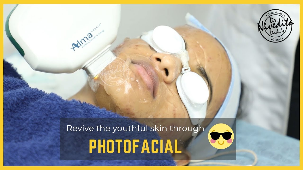 Photofacial treatment for Skin Lightening & Skin whitening 