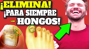 ¿Cómo eliminar las uñas gruesas?