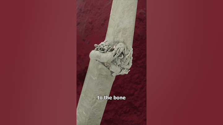 You Should Never Ignore A Broken Bone 😬