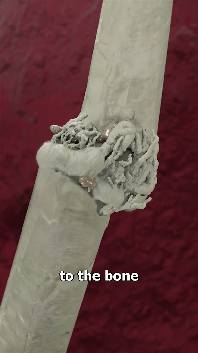 You Should Never Ignore A Broken Bone 😬