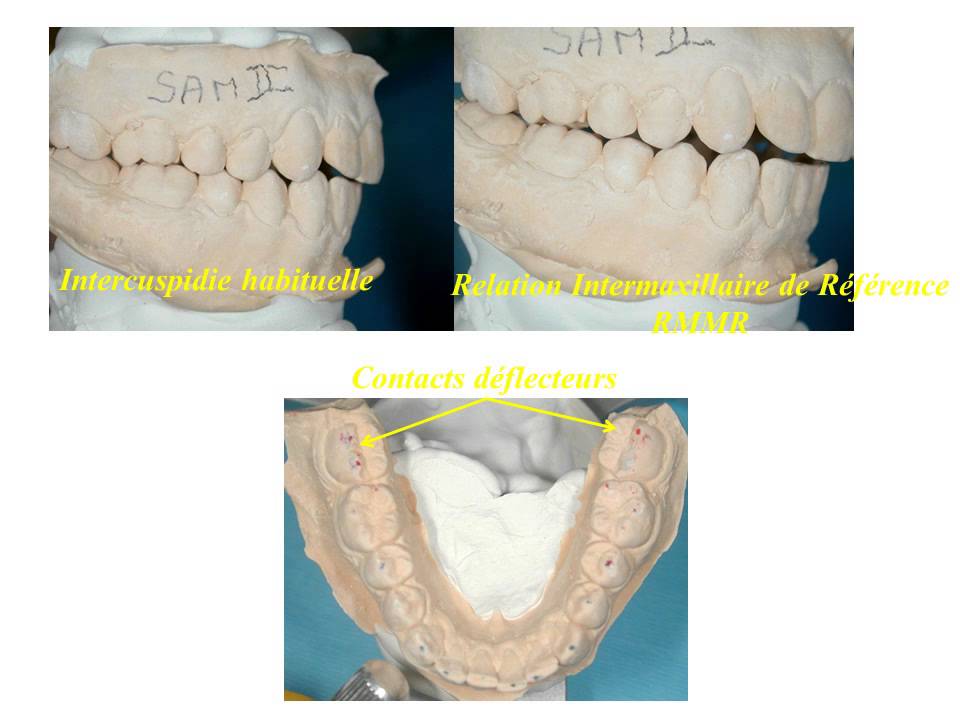 Ortho-5 L'équilibrage occlusal