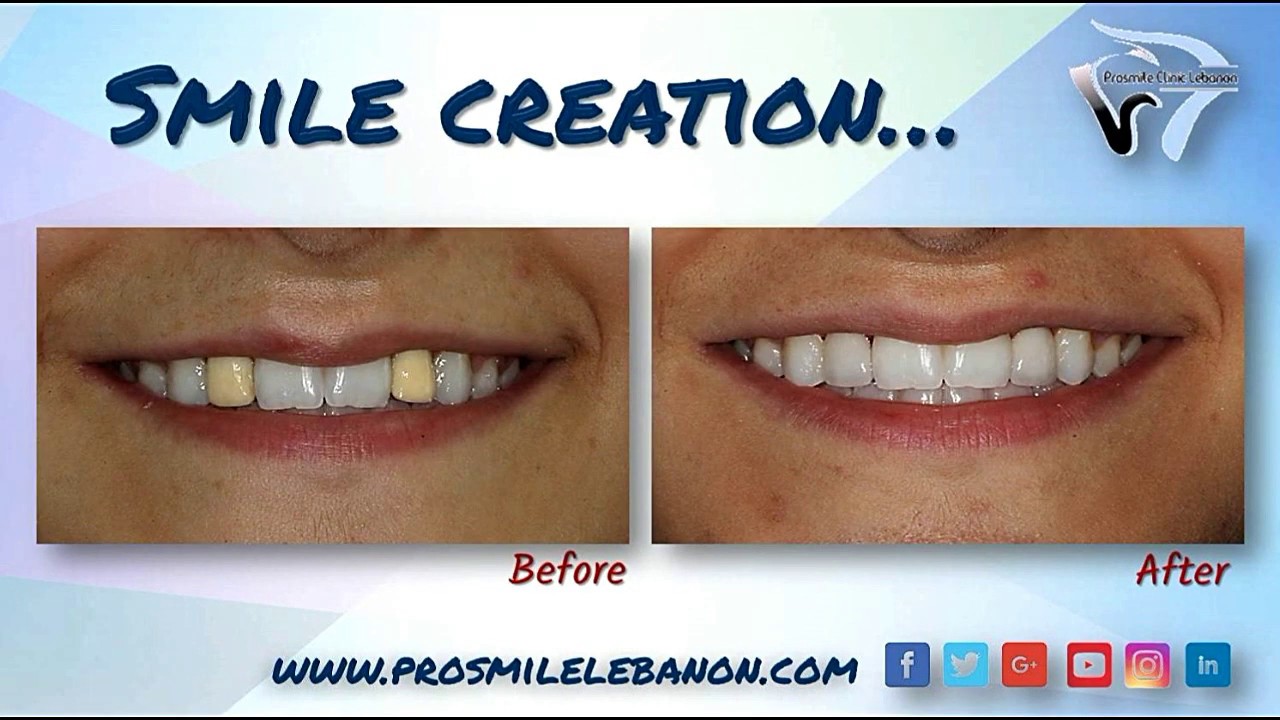 ProSmile Clinic Lebanon Clinical Cases YouTube