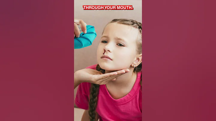 How to treat a nose bleed #shorts