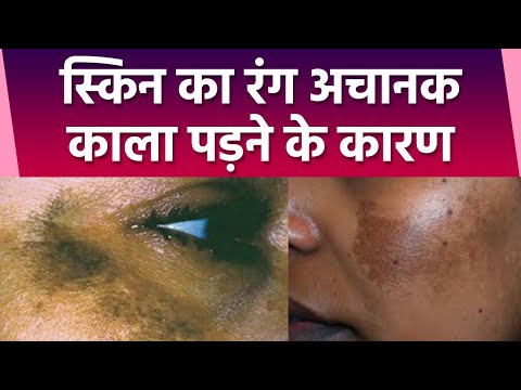 वीडियो: धूप के संपर्क में आने पर आपकी त्वचा का रंग काला क्यों हो जाता है?