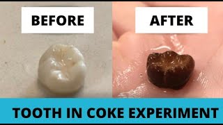 Leaving A Tooth In Coke For 6 Weeks