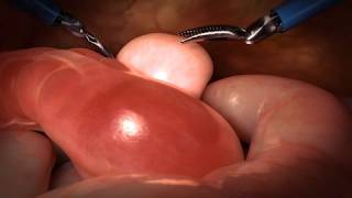 Robotic Surgery to Remove the Bladder and Prostate Gland
