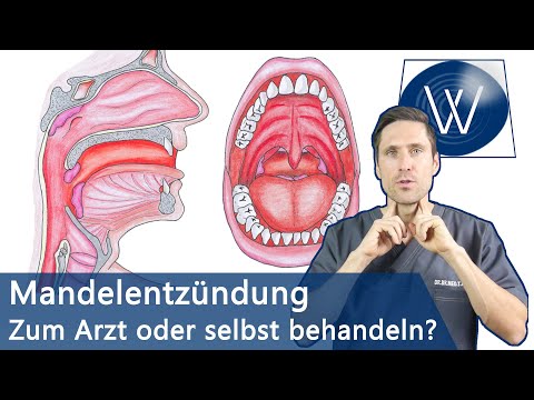 Mandelentzündung \u0026 Halsschmerzen: Schnell loswerden \u0026 Was Sie wissen müssen wenn Sie betroffen sind!