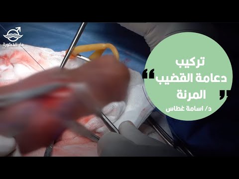 تركيب دعامة القضيب المرنة الدكتور اسامة غطاس 4971