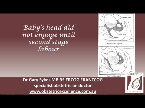 Baby's head did not engage until second stage labour