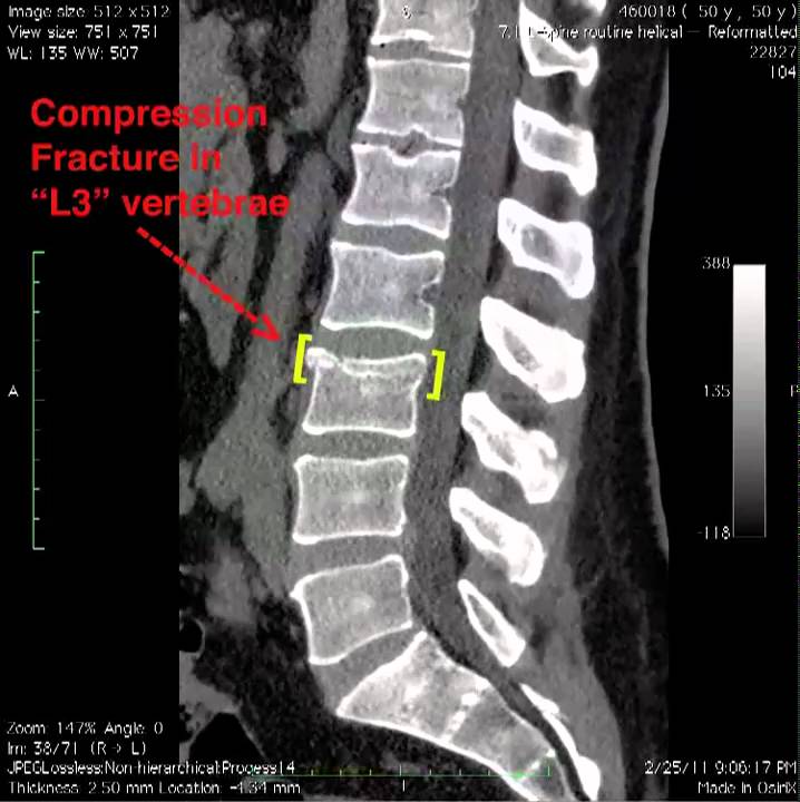 L3 Spinal Compression Fracture.mov - YouTube