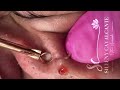 blackhead removal from nose/ old aged blackheads removal | #33