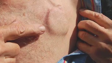 Keeping Pace with Pacemakers