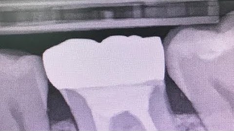 Review of Eighteeth Nanopix Digital X-ray Sensor