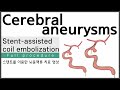 Stent-assisted coil embolization of the cerebral aneurysms: full procedure scene