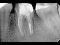 Instrument separation in tooth  36