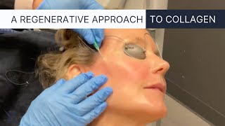 PDO Thread Lift, the Ultimate Non-Surgical Facelift