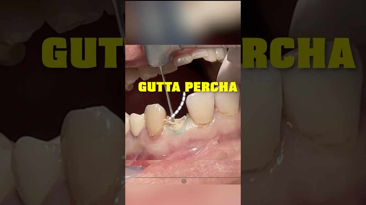 What Happens When A Root Canal FAILS! 😳🦷