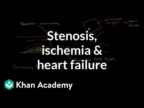 Stenosis, ischemia and heart failure | Miscellaneous | Heatlh & Medicine | Khan Academy