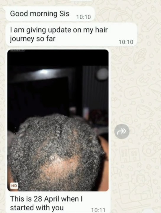 Before and After with CCCA / If you are struggling with  FFA inflamed scalp, buy these combo