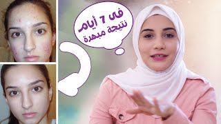 مهما كانت بشرتك مليانة حبوب .. دا الحل النهائى وب 20 جنيه بس