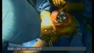 Total Knee Arthroplasty - Rotating Platform High Flex Knee - Computer Assisted Surgery (Part 4 of 5)