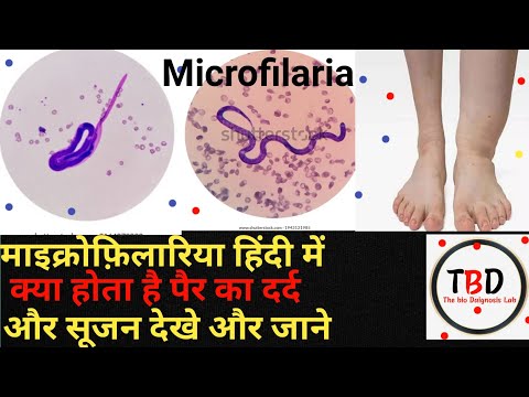 Microfilaria test in hindi laboratory |