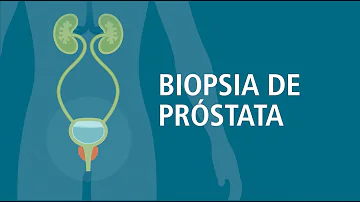 ¿Cuáles son los efectos a largo plazo de una biopsia de próstata?