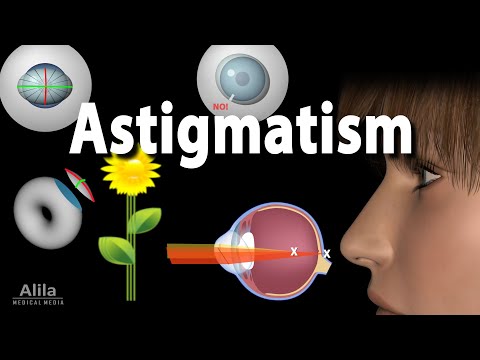 Astigmatism: Symptoms, Tests & Treatment