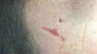 Acne scars, subcision