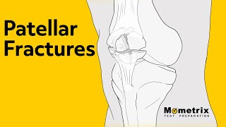 Patellar Fractures | NCLEX Review